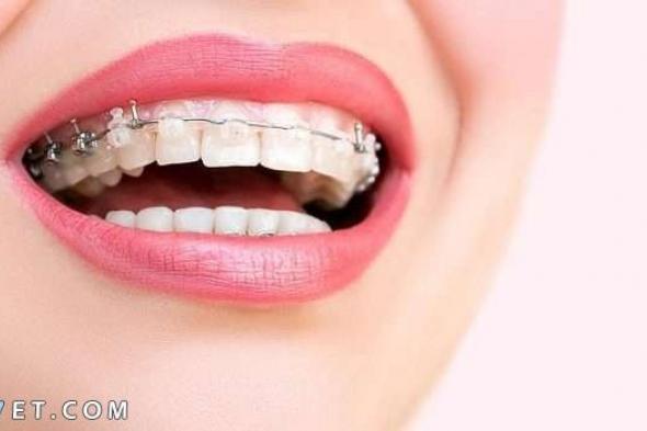 كيفية ازالة تقويم الاسنان بالخطوات