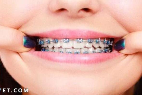 طريقة تركيب تقويم الأسنان