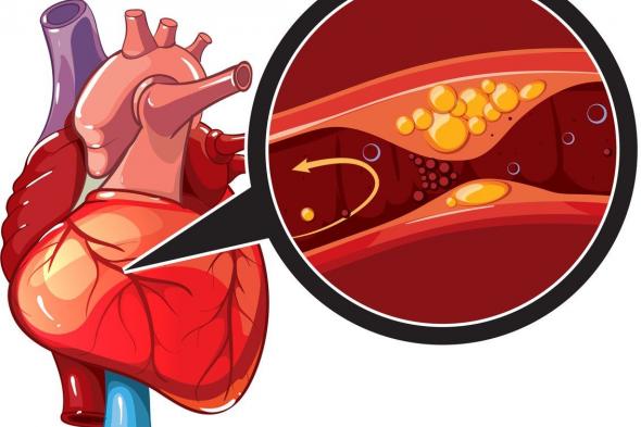 الداء القلبي الإكليلي أو مرض الشريان التاجي: الأسباب والأعراض والتشخيص والعلاج