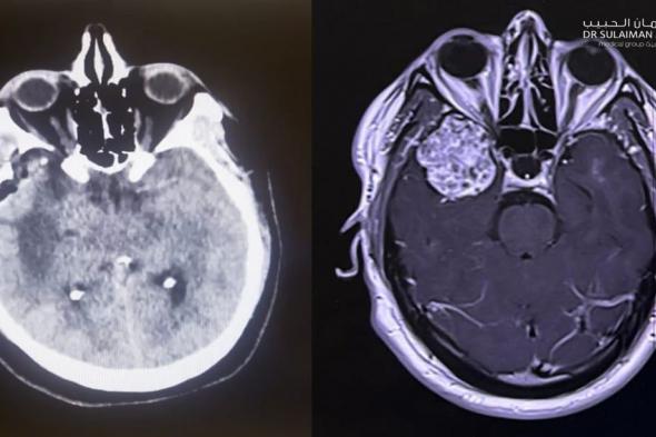 مستشفى الدكتور سليمان الحبيب بالخبر يستأصل ورماً دماغياً سبب فقدان الوعي وتشنجات حادة لخمسيني