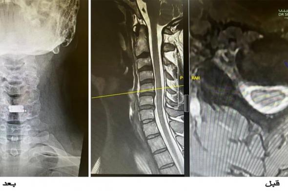 مستشفى الدكتور سليمان الحبيب بالسويدي يجري جراحة لاستبدال غضروف الرقبة وتوسيع القناة الشوكية لمراجع أرجنتيني