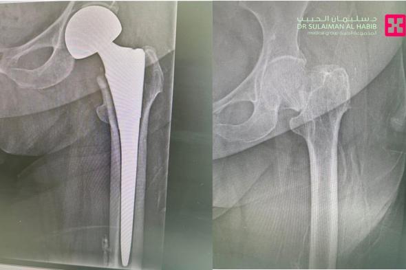 مستشفى الدكتور سليمان الحبيب بالفيحاء في جدة يُجري عملية استبدال مفصل الورك لـ"ثمانينية" بحالة صحية معقدة