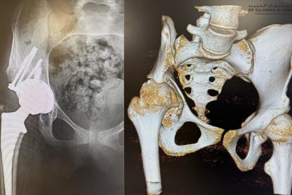 مستشفى الدكتور سليمان الحبيب بالتخصصي يُجري عملية ناجحة لاستبدال مفصل الورك لشابة "كويتية"