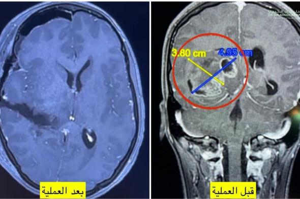 مستشفى الدكتور سليمان الحبيب بالقصيم ينقذ "كويتية" من كتلة ضخمة ضاغطة على الدماغ