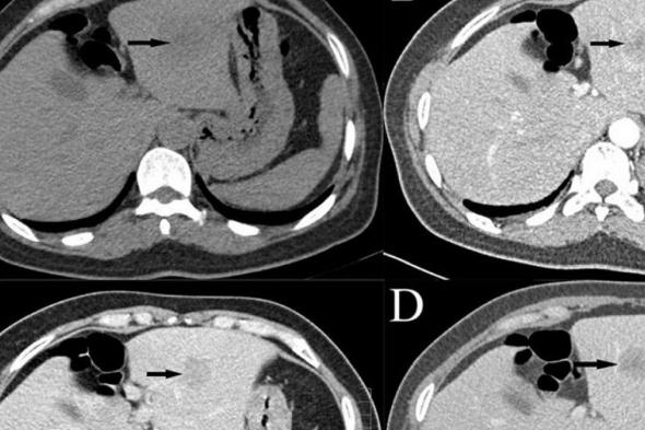 باستخدام الذكاء الاصطناعي.. طريقة مبتكرة لتحديد نوع أورام الكبد بدقة
