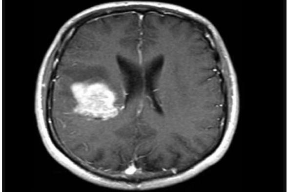 دواء لضغط الدم يعالج أورام الدماغ