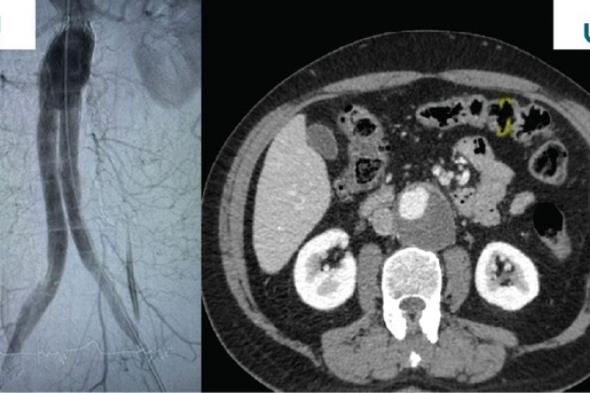 نجاح عملية إصلاح تمدد الشريان الأورطي البطني لمريض يبلغ من العمر 69 عامًا