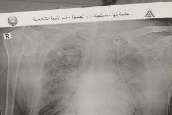إنقاذ حياة مريض يعانى من غرغرينا بالقولون والأمعاء الدقيقة بمستشفى بنها الجامعى