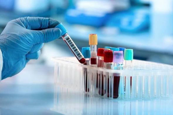 تحليل دم يتنبأ بدقة بتطور أمراض الكلى