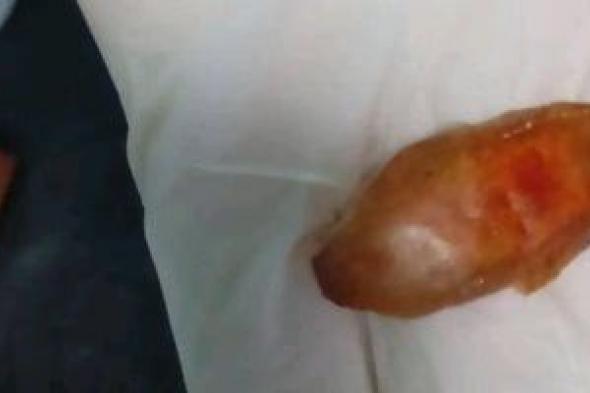 مستشفى بالشرقية ينقذ رضيعا عمره 45 يوما تعرض لتوقف القلب بعد ابتلاع بلحة