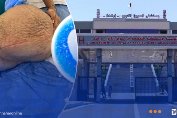 إنجاز
طبي
نادر
بمستشفى
الحروق
الكبری
الدكتور
سعيد
شيبان
-
زرالدة