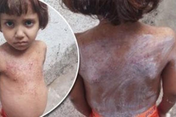 جودى
حنون..
طفلة
فلسطينية
فقدت
شقيقتيها
وتعانى
من
مرض
خطير
يحتاج
لزراعة
نخاع