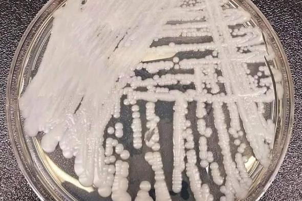 فطر
قاتل
مقاوم
للعلاج
ينتشر
في
مستشفيات
أمريكية