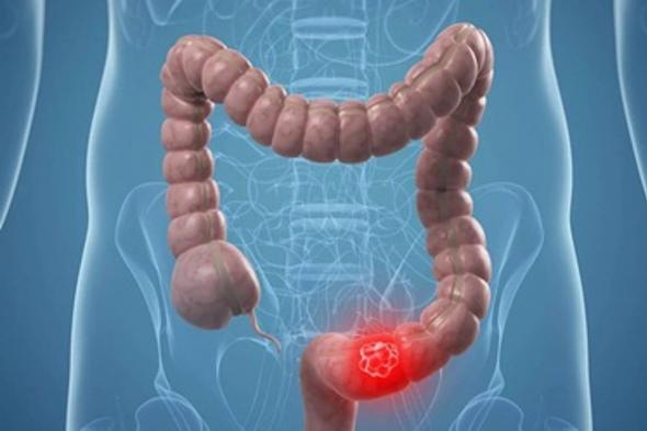 دراسة:
    أدوية
    الكوليسترول
    يمكن
    أن
    تقلل
    الإصابة
    بسرطان
    القولون
    بنسبة
    23
    %