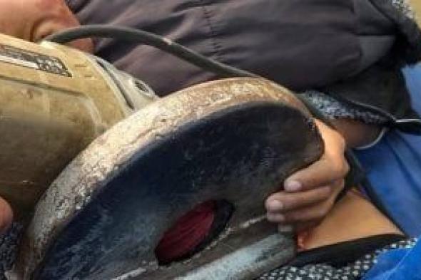 فريق
طبى
ينجح
فى
استخراج
منشار
كهربى
استقر
فى
بطن
طفل
بدمياط