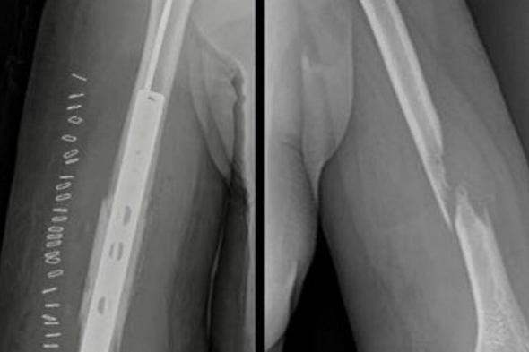 إعادة
حركة
يد
خمسينية
بعد
جراحة
دقيقة
لأورام
العظام
في
المدينة