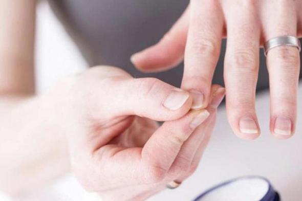 اصفرار الأظافر.. يستدعي القلق أحياناً