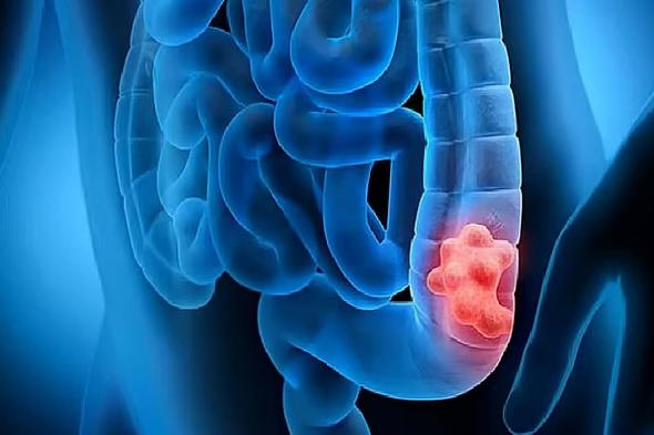 تجمع
    الرياض
    الصحي
    يوضح
    أسباب
    الإصابة
    بالقولون
    العصبي
    وطرق
    علاجه