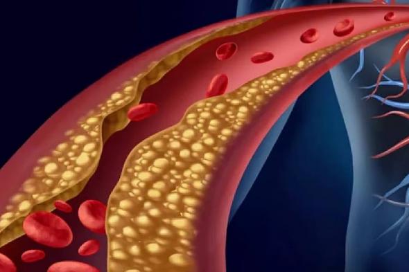 فهد
    الطبية
    توضح
    عوامل
    خطورة
    الإصابة
    بتصلب
    الشرايين
    والأمراض
    الناتجة
    عنه