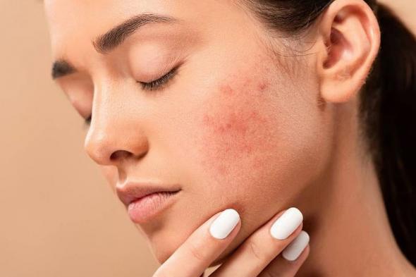 «اللابتوب»
    أحد
    أسبابها..
    ما
    هى
    متلازمة
    «الجلد
    المحمص»؟