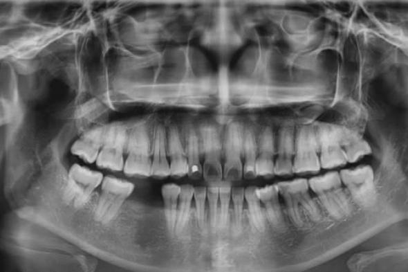 لعاب
      من
      قصب
      السكر
      لحماية
      أسنان
      مرضى
      السرطان