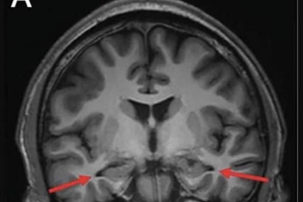 صيني
      19
      عاماً
      أصغر
      مصاب
      بالزهايمر
      في
      العالم