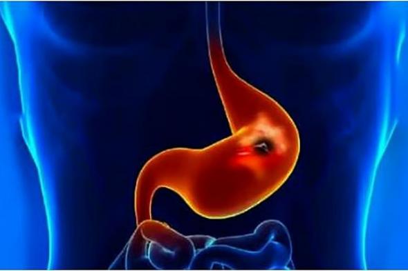 فقدان
    الوزن
    والشهية..
    تعرف
    على
    أعراض
    جرثومة
    المعدة
    وطرق
    الوقاية
    منها