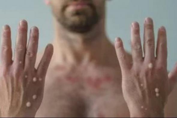 المركز الأفريقى لمكافحة الأمراض يرفع حالة الطوارئ المرتبطة بجدرى القرود