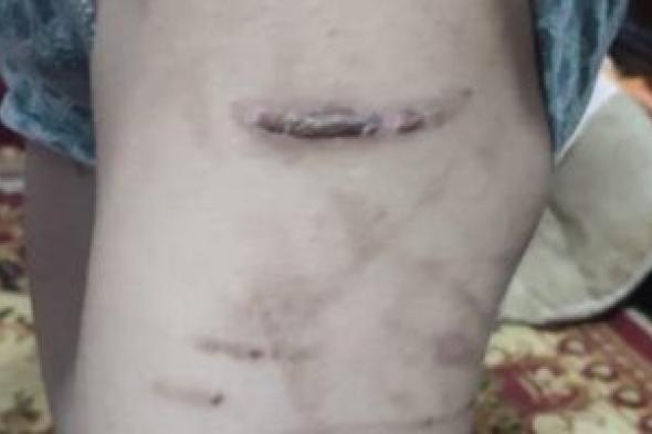 بلاغ
يتهم
زوجة
أب
بتعذيب
نجل
زوجها
واحتجازه
بالفيوم