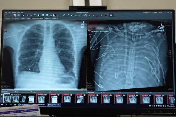 أمريكي
يعيش
يومين
بلا
رئتين