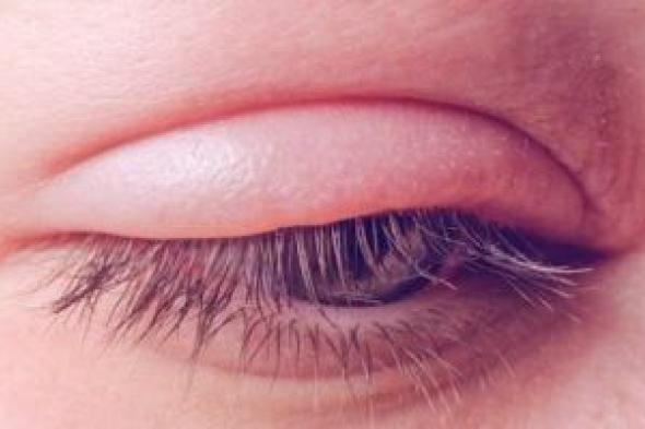 أسباب
تورم
العين
بسبب
الحساسية..
اعرف
طرق
العلاج
الفعاله