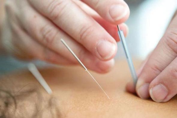 جلسة علاج بالوخز بالإبر تتحول إلى كابوس